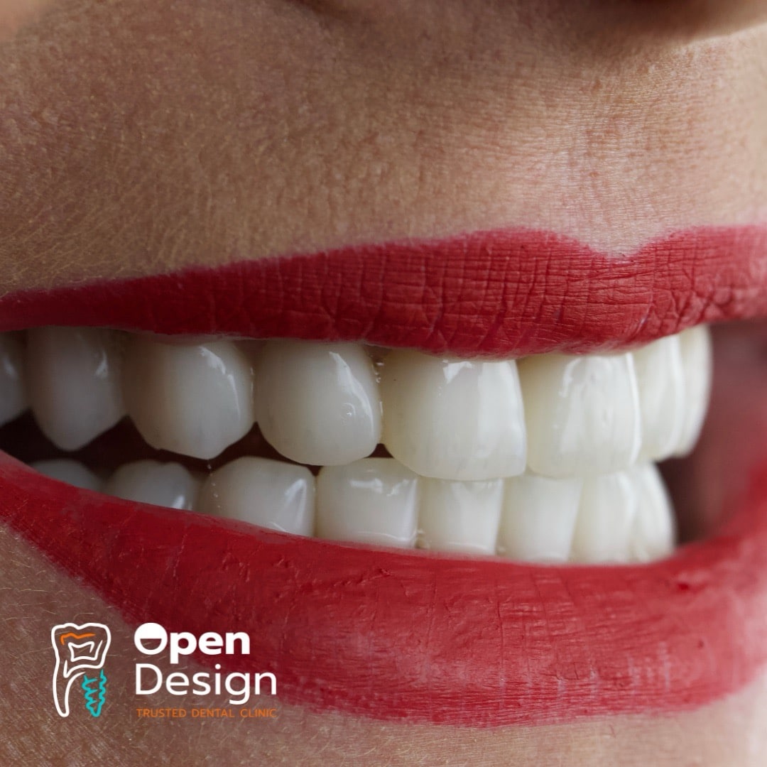 Dentist Alba Iulia implant dentar coroane zirconiu Open Design